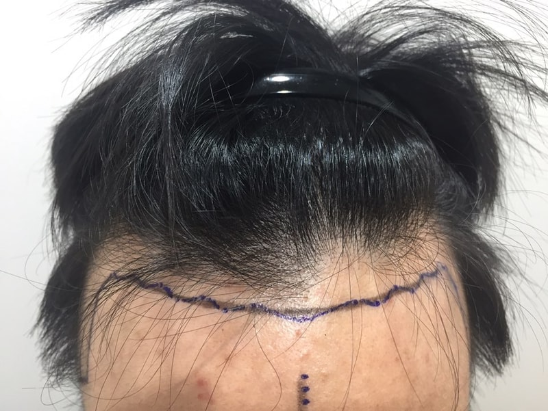비절개 10일차, 수술 후기입니다.