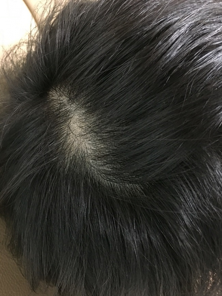 수술전 정수리.JPG