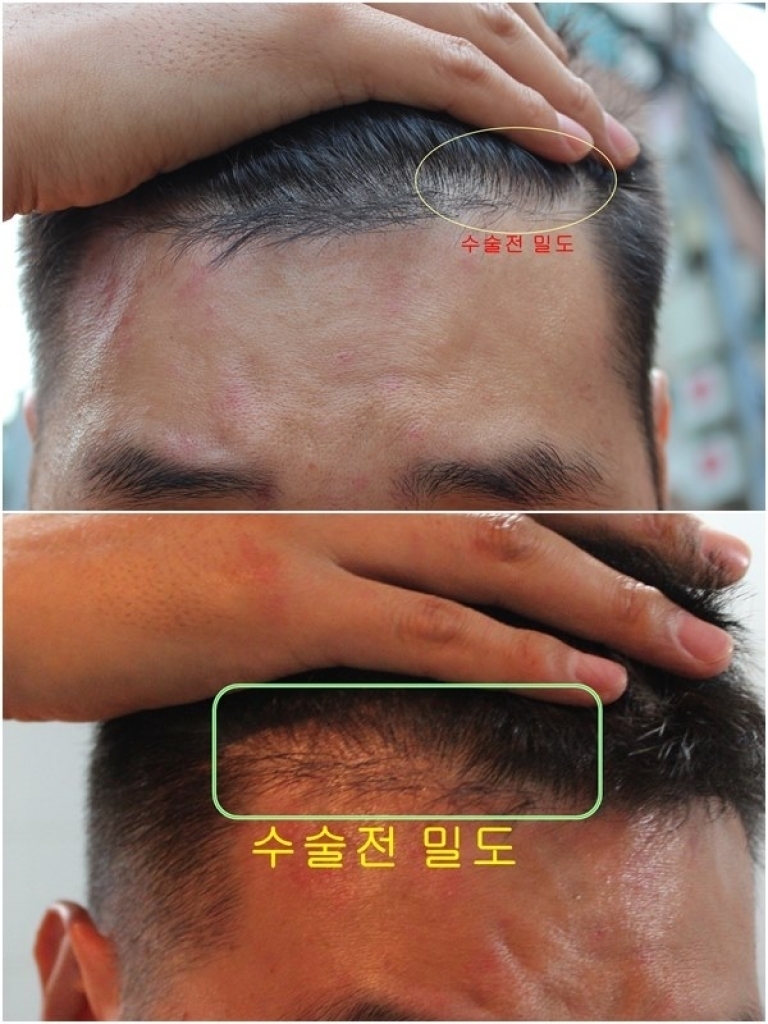 뉴헤어 수술후기입니다