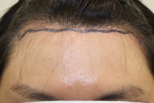 Daegu HAIRO HAIR TRANSPLANT CENTER Hair Transplant 1200 Mo 40 days review