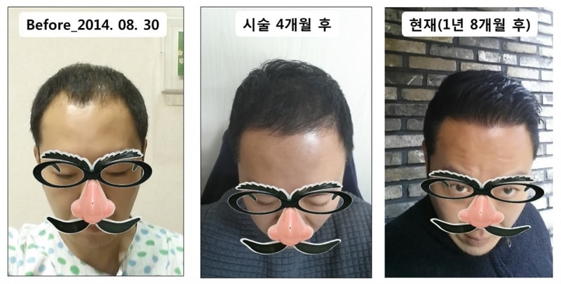 뜸금없이 올리는 JP 5천모 절개 시술 후 20개월 경과 보고