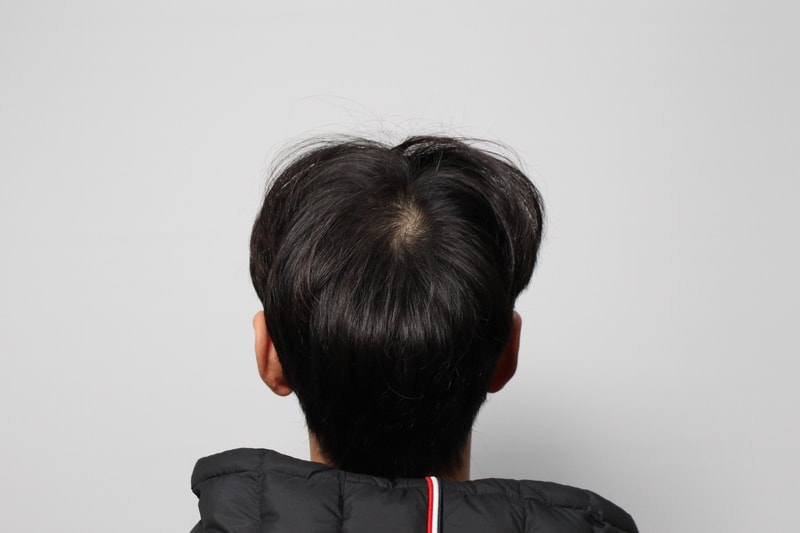대전_모발이식_병원_추천_후기글수술_전.JPG