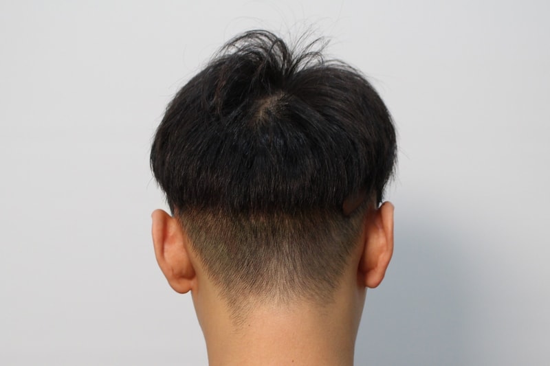 대전_모발이식_병원_추천_후기글수술_후.JPG
