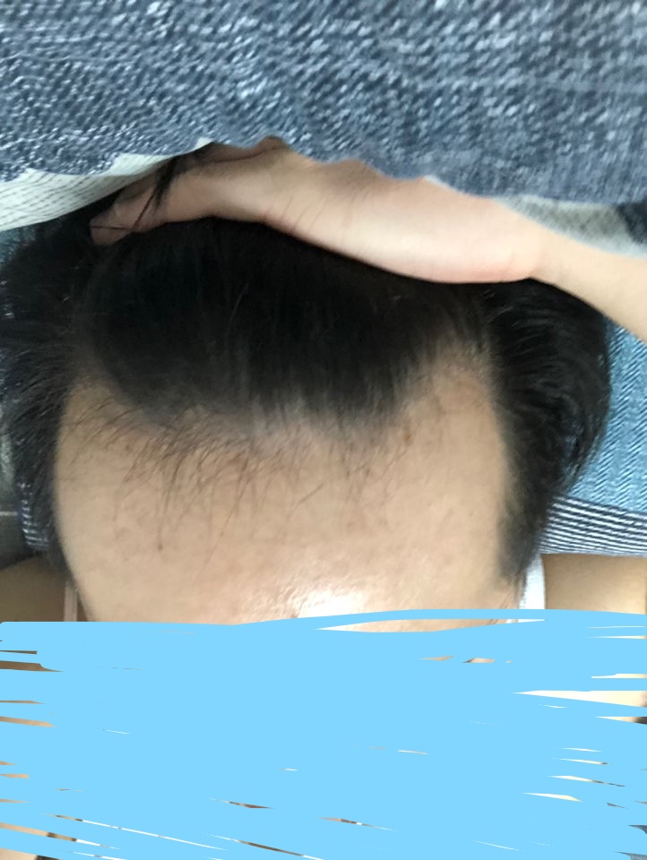 뉴헤어 절개 슬릿 1500모낭 3일차 상세 후기 남깁니다.