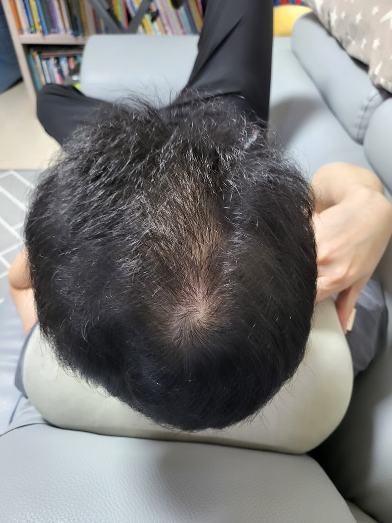 모발이식 8개월 후-1.jpg