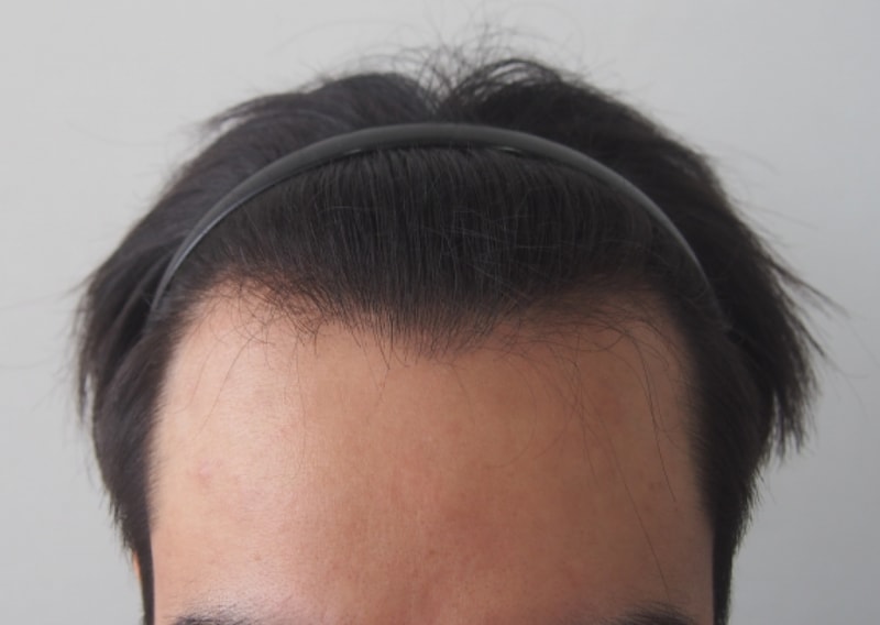 비절개 수술한지 9개월 됐습니다.