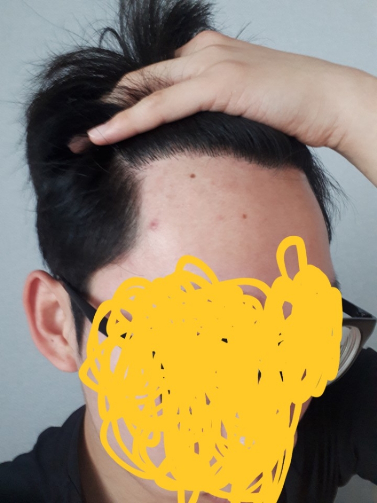 절개 8개월차 경과 올립니다