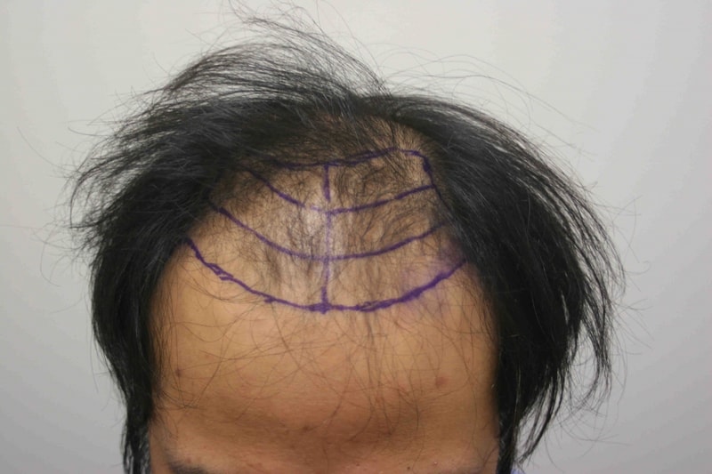 포맷변환_수술전.jpg