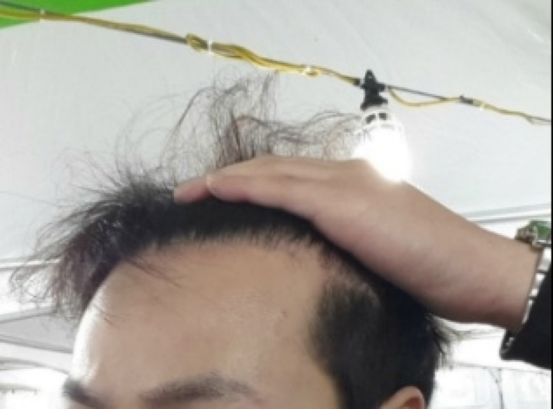 비절개모발이식 (5).jpg
