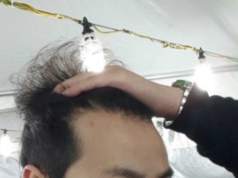 비절개모발이식 (6).jpg