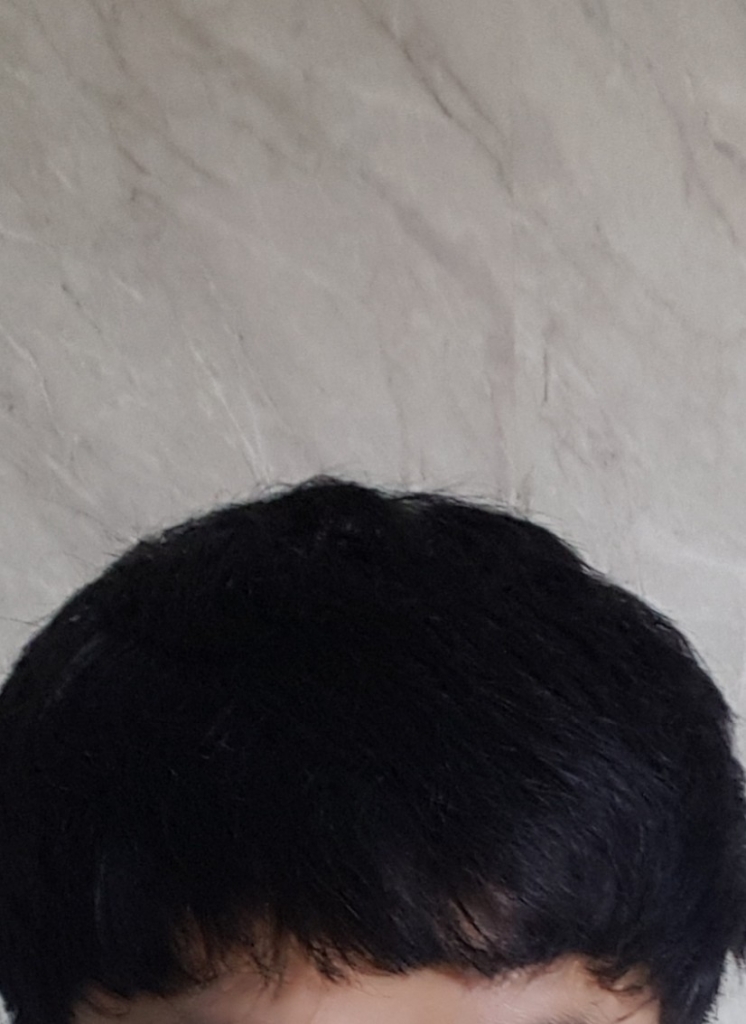 벌써 수술받은지 13개월이 됐네요. 오랜만에 후기올립니다