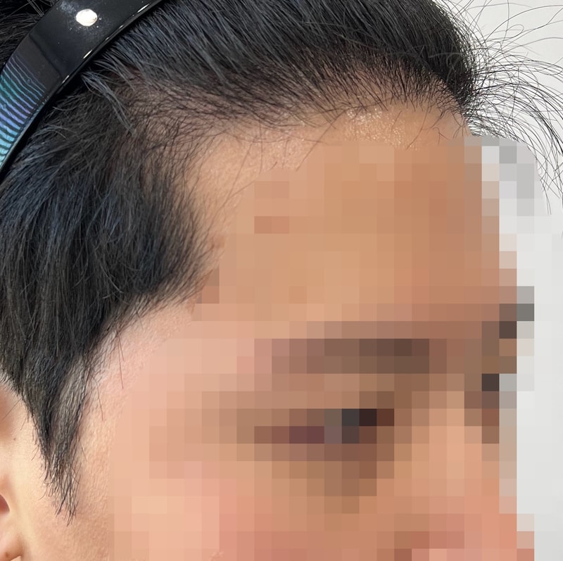 모재성 성형외과 모발이식 후기 4달차(대략 130일차)