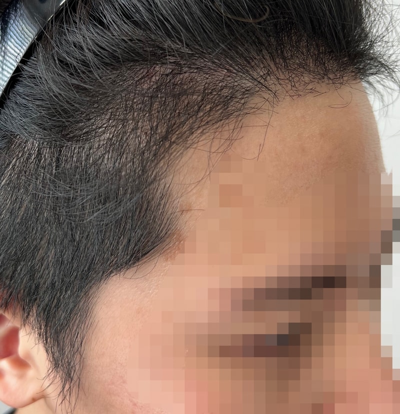 모재성 성형외과 모발이식 후기(42일차)