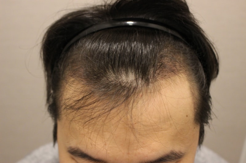 수술 열흘 후.jpg