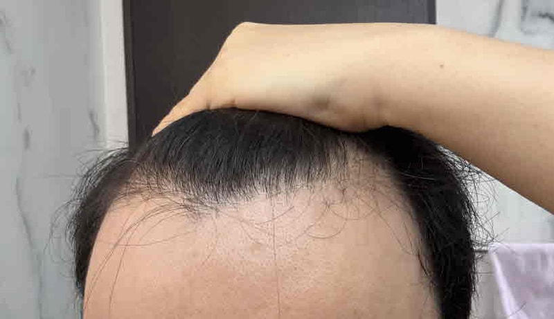 비절개 무삭발 모발 이식
