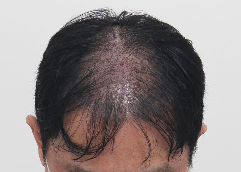 04.수술다음날 샴푸 후.JPG