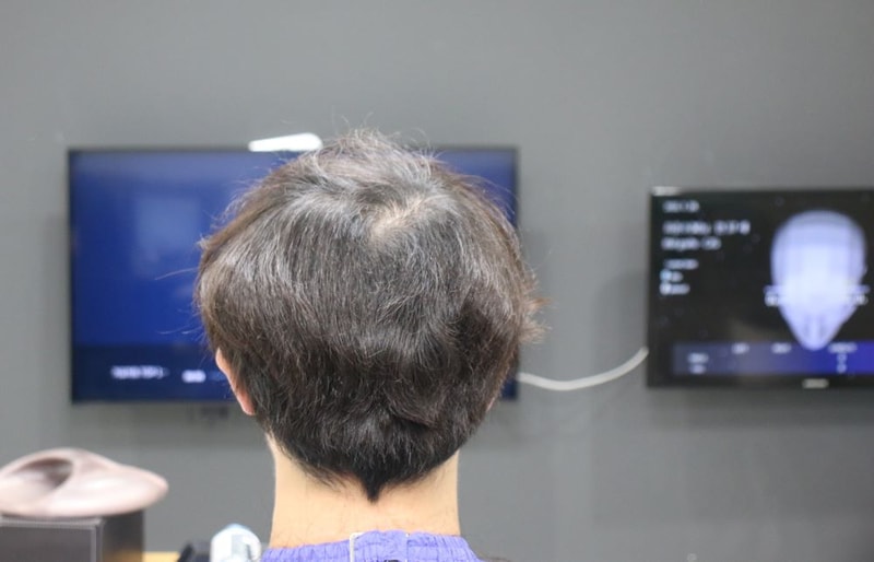 01.후두부 부분삭발전.JPG