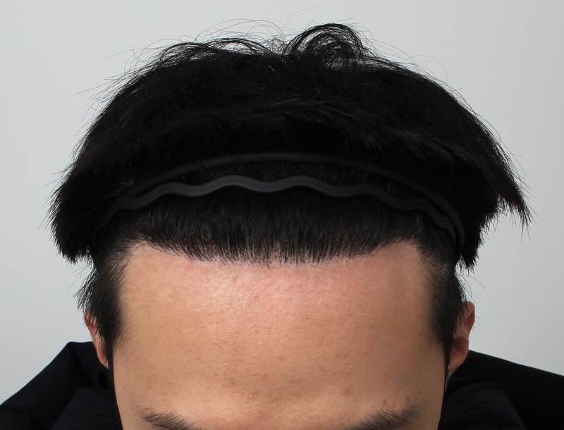 01.수술9개월차.JPG
