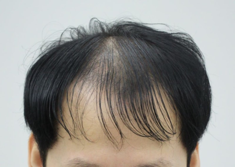 즐거운 여름휴가! 압구정 포헤어 전두부 비절개모발이식 7개월 후기