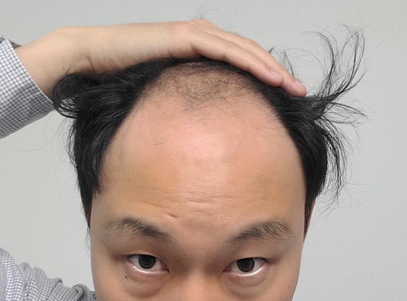 4034모 대량이식 서울 포헤어의원 비절개모발이식 4개월차 후기