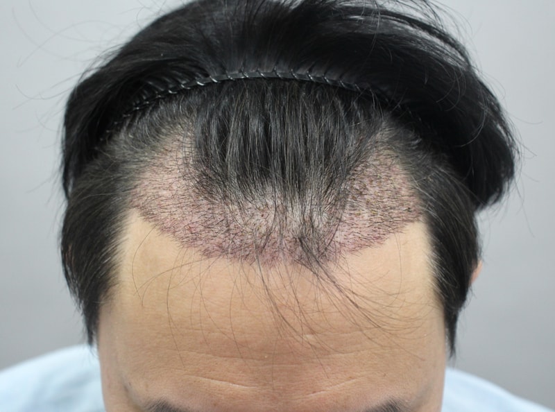 07.수술2주차.JPG