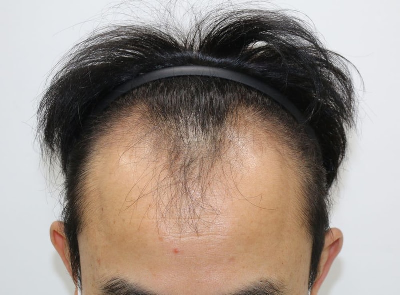 꽃중년을 위한 준비 압구정포헤어의원 비절개슬릿 4개월차 후기