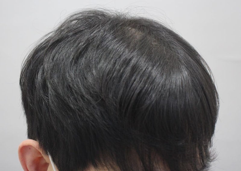 10.수술9개월.JPG