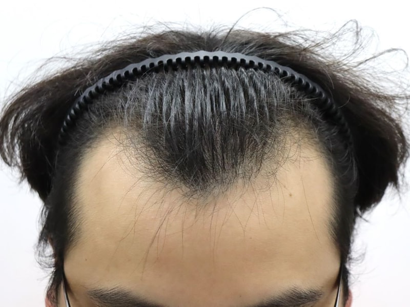 압구정 포헤어 M자탈모 비절개모발이식 암흑기 진입 1달 후기