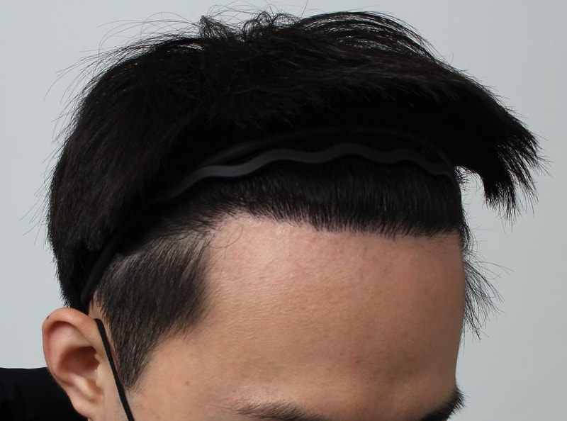 03.수술9개월차.JPG