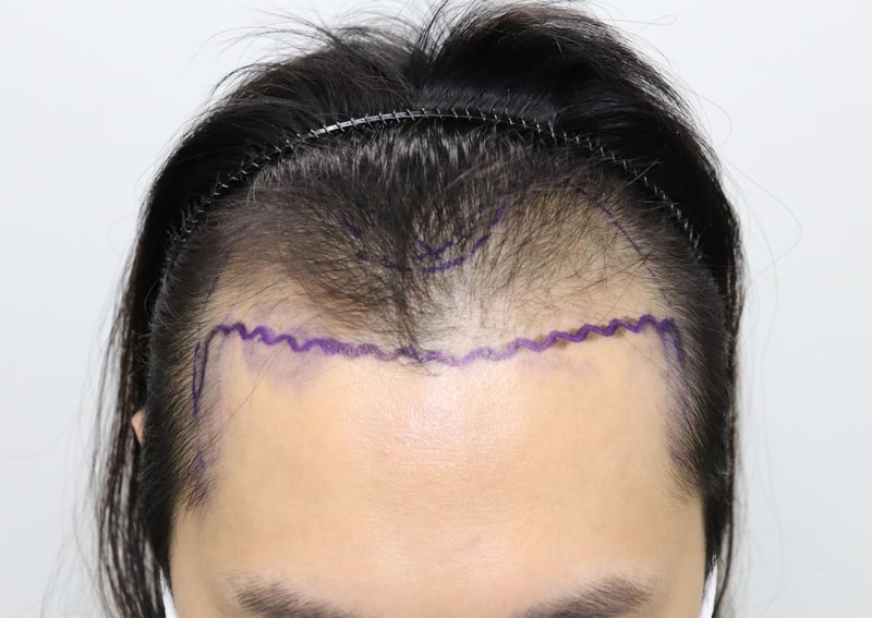 01.수술전.JPG