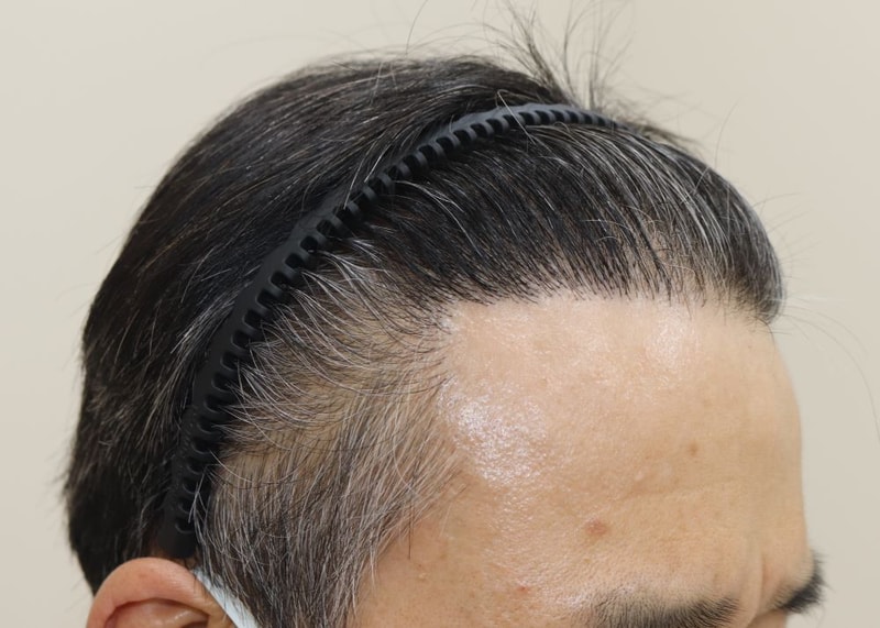 06.수술9개월차.JPG