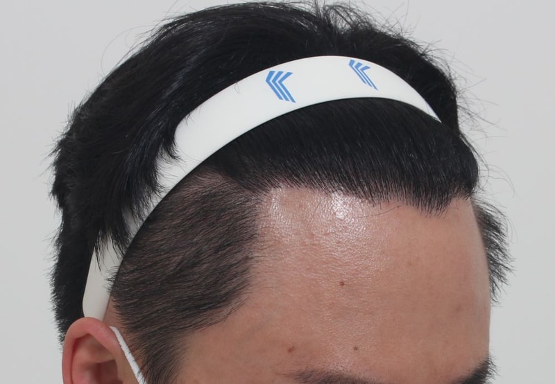 08.포헤어에서 재수술후 8개월차.JPG