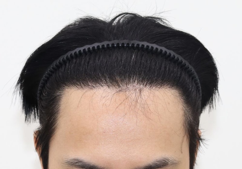04.수술후.JPG