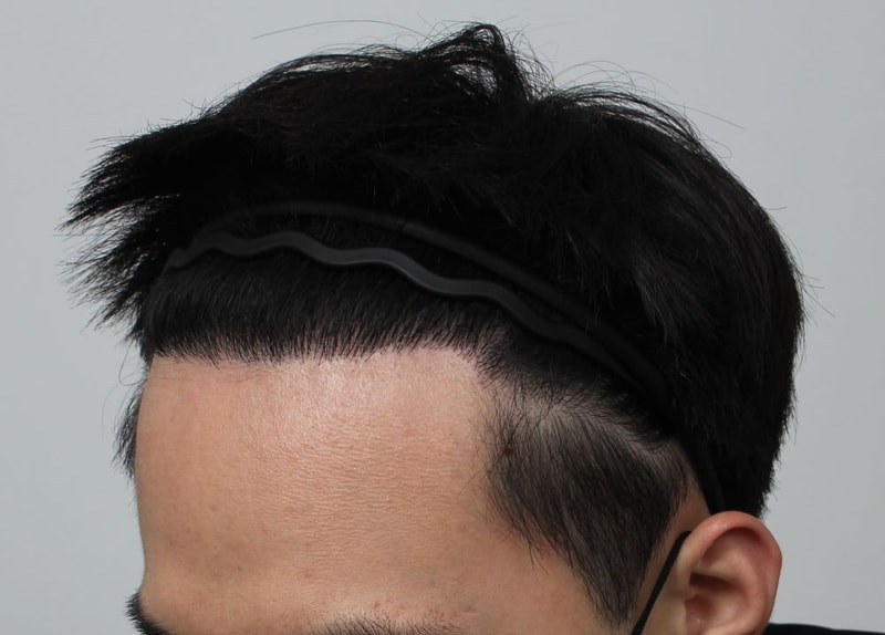 02.수술9개월차.JPG