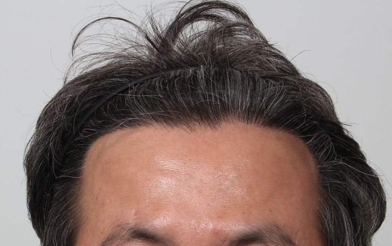 2.수술후.JPG
