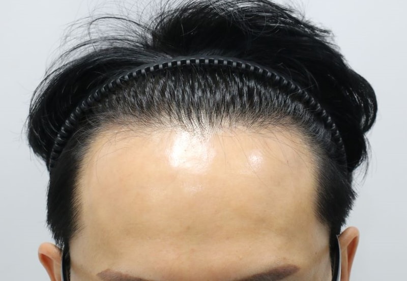 최고의 결과라 생각합니다. 압구정 포헤어 민영기원장님 비절개슬릿 모발이식 9개월 후기