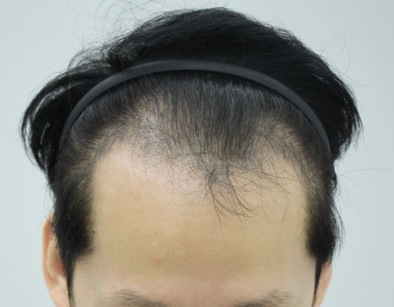 압구정 포헤어슬릿 전두부 비절개모발이식 4개월 후기