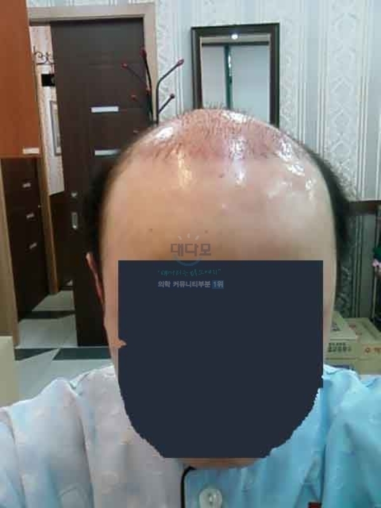 절개수술사진.jpg
