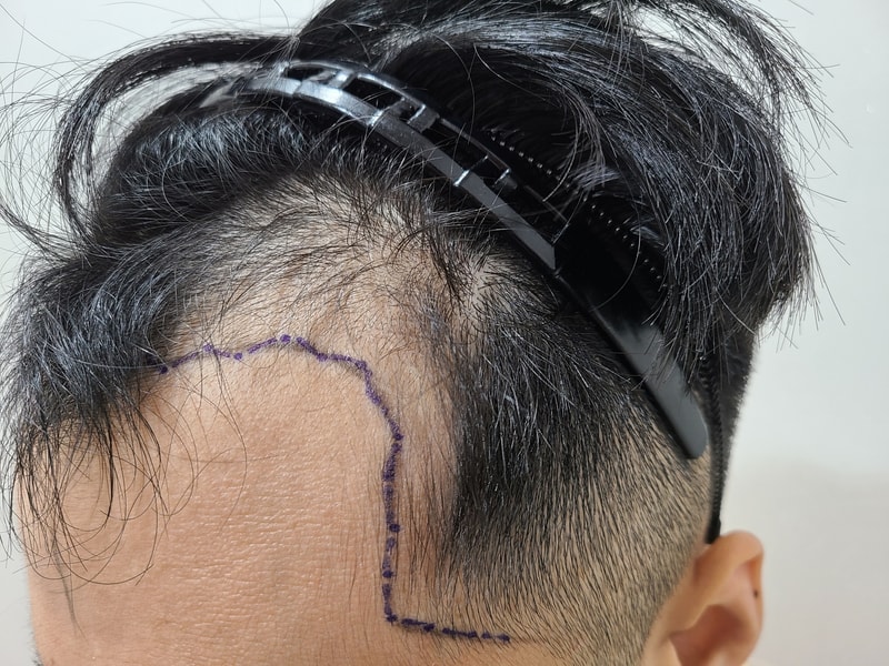 모바른 한상보 비절개 3500모 3일차