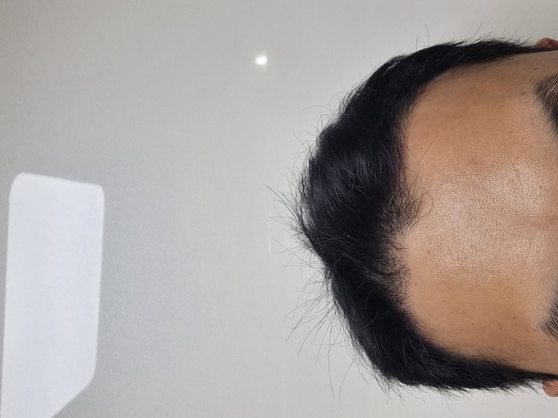 수술 4개월차 후기 입니다