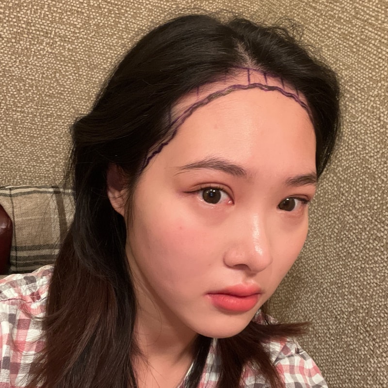 절개 모발이식 9개월차 후기!