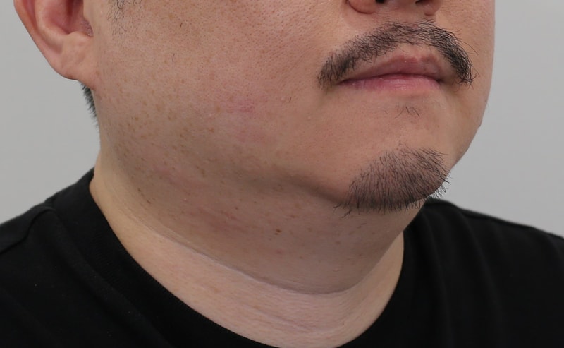 수염이식 (수염 모발이식) 비절개 7개월 후기입니다. (압구정 맘모스헤어라인의원)