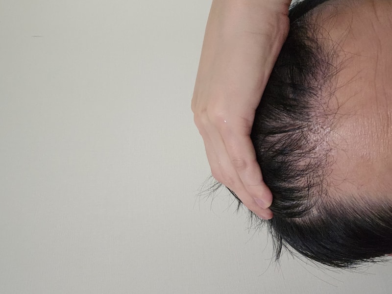 비절개 4200모 5개월 후기