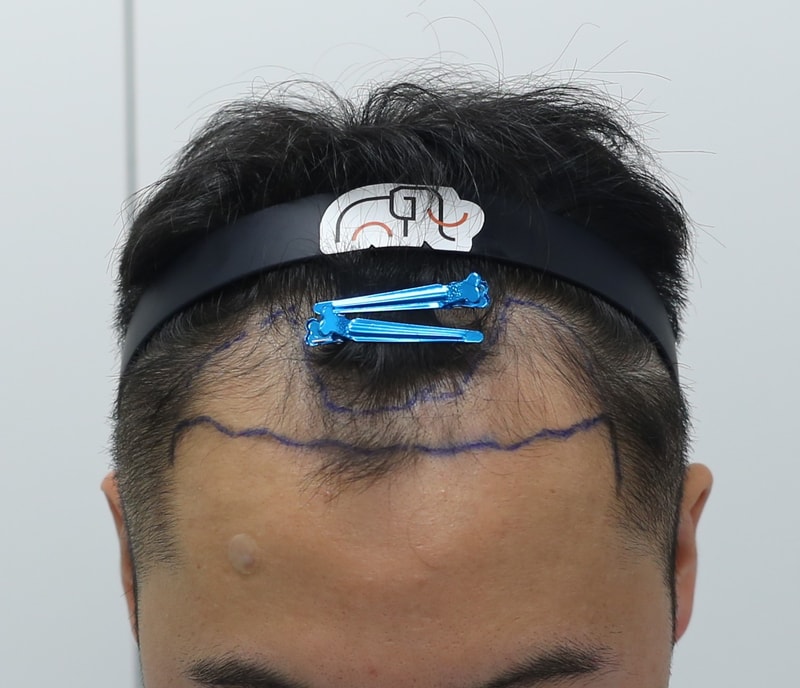 압구정 맘모스헤어라인 모발이식 1485일차 입니다
