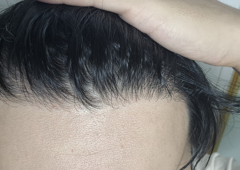 Non-intersected 3,200 Mo 1st Year Surgery Review