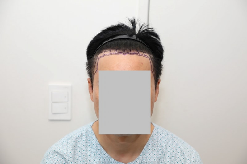 1800 Hair follicle non-cut M Zama transplantation (7th day)