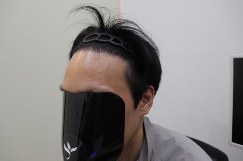 광주압구정모비앙 모발이식 6개월경과후기