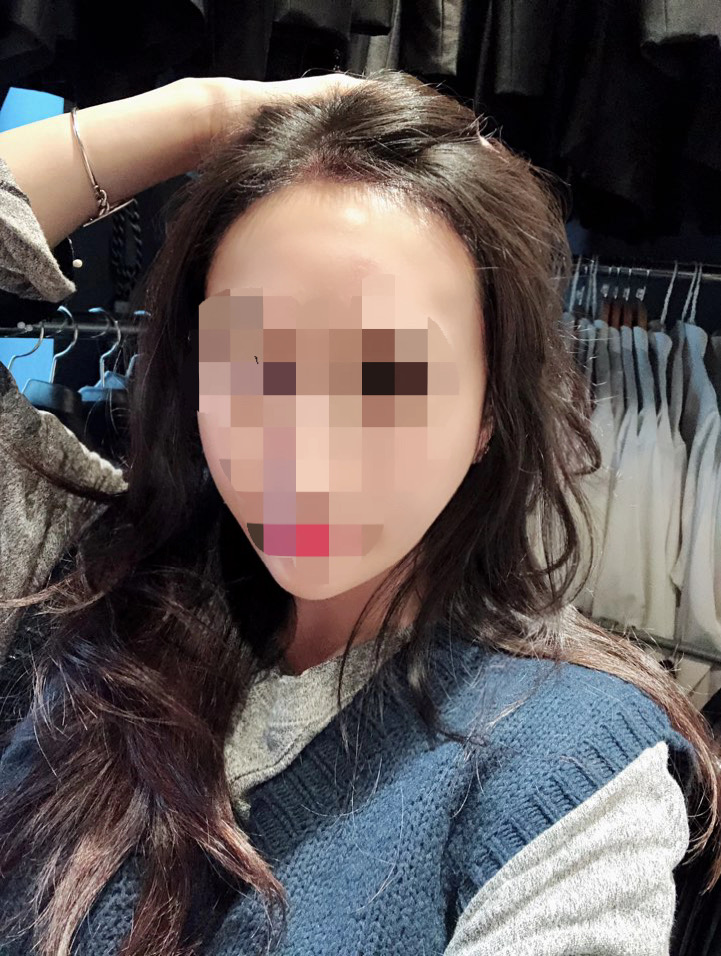 다나에서 헤어라인 절개 한달정도 됬네요~^^