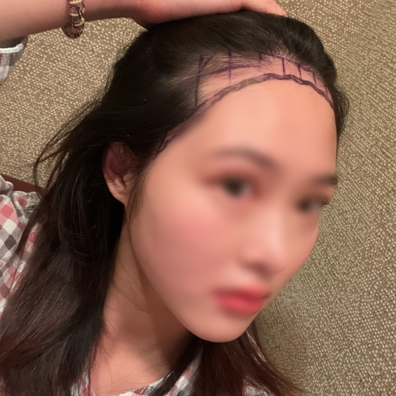 ㄴㅎㅇ절개 1600모낭 4개월차 후기