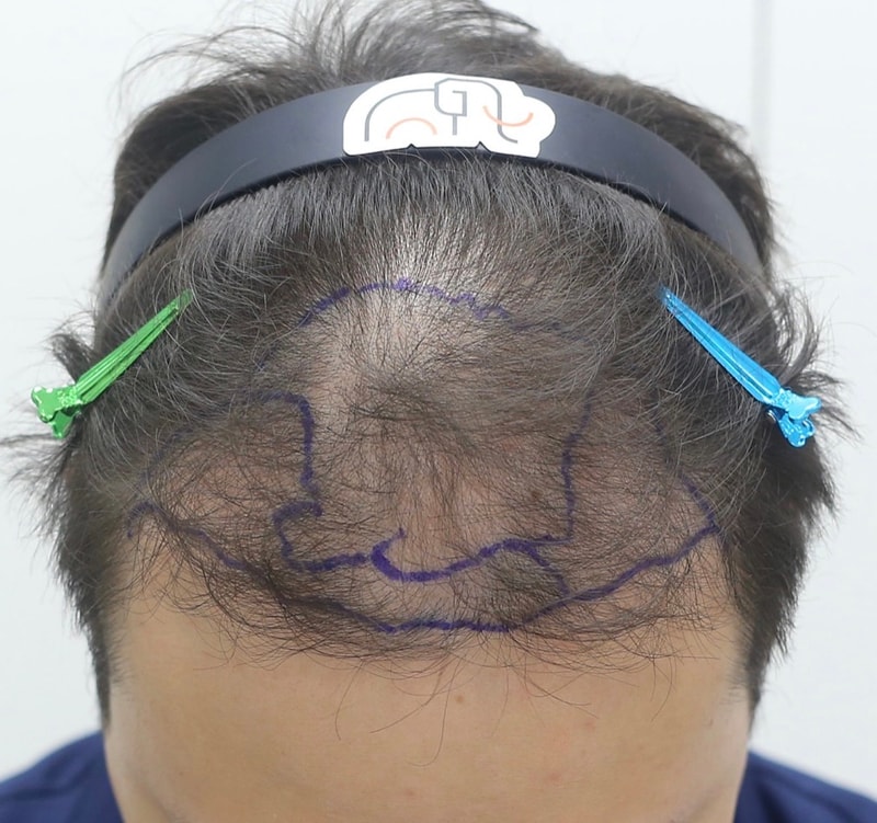 장기 후기 도움되면 좋겠네요. 확산성 탈모 1년 8개월입니다.